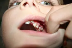עששת אצל ילדים
